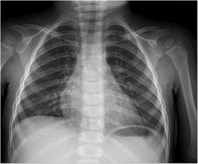 Case Report: Heart aneurysm of unknown origin in a two-year-old child diagnosed in the course of Multisystem Inflammatory Syndrome in Children